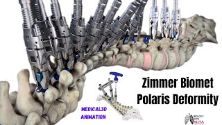 Zimmer Biomet  Polaris Deformity  Medical 3D Animation  BiologywithAliya [upl. by Sadler]