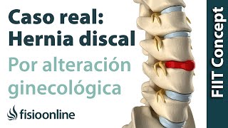 Hernia discal lumbar por una alteración ginecológica  Caso clínico real [upl. by Nivert539]