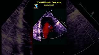 WMA Akinesia Dyskinesia Aneurysm [upl. by Merc482]