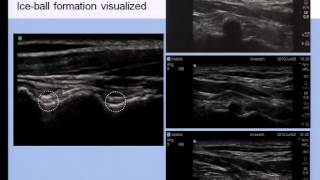 Pain Medicine  Role of Ultrasound Imaging in Neuraxial Pain Procedures [upl. by Kinemod]