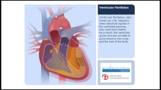 Ventricular Fibrillation Animation Video [upl. by Jock42]