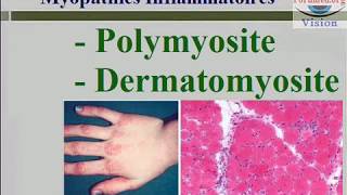 Les Myopathies inflammatoires  Polymyosite et Dermatomyosite Faiblesse musculaire [upl. by Adnovahs]