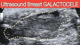 BREAST GALACTOCELE  Ultrasound  Breastfeeding Complication  Milk Cyst [upl. by Papke]