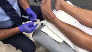 Ankle Steroid injection [upl. by Roddy735]