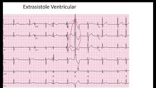 Comparación Extrasistole Auricular vs Ventricular EKG [upl. by Lud]