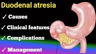 duodenal atresia  causes  clinical features diagnosis  management [upl. by Essirahs]