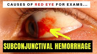 Causes of Red Eye  Part 1 SUBCONJUNCTIVAL HAEMORRHAGE blood on the eyeball [upl. by Anchie]