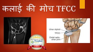 TFCC Injury Hindi Wrist ligament Injury कलाईकीमोच [upl. by Le]