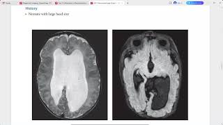 NEURORADIOLOGY EXAM CASES LECTURE [upl. by Hart458]