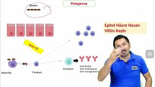 Çölyak Hastalığı Patofizyoloji temelli anlatım DRPATOLOJICOM [upl. by Augustin]