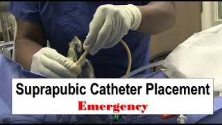 Emergency Suprapubic Catheter Placement [upl. by Sluiter]