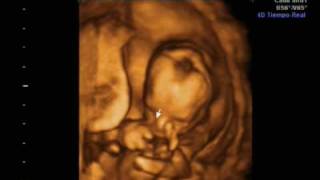 Ecografia 16 semanas 4D y 2D Ultrasound Irati [upl. by Eiramenna]