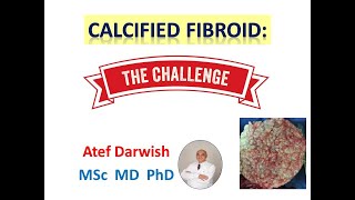 calcified fibroids therapeutic challenges [upl. by Intruoc497]