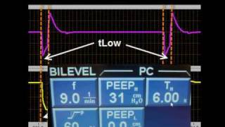 APRV BiLevel BiVent amp DuoPAP 2 [upl. by Moreno]