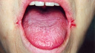 Angular Cheilitis ReviewHow To Treat Angular Cheilitis [upl. by Zakaria]