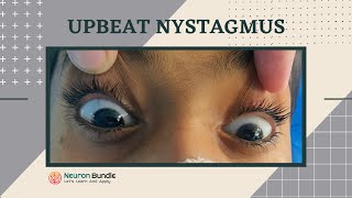 nystagmus  eye movements l demo on a patient l horizontal amp vertical nystagmus neurology [upl. by Fritts]