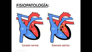 Estenosis aortica 2024 [upl. by Ynnaej]