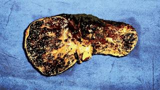 A Family Ate 1 Year Old Frozen Leftovers For Breakfast This Is What Happened To Their Organs [upl. by Aterg518]