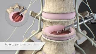 Spineology OptiLIF® Endo [upl. by Anelet303]