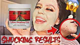 I USED THE AZTEC HEALING CLAY MASK WITH WATER ON MY SKIN FOR 5 DAYS CRAZY RESULTS [upl. by Aehsila]