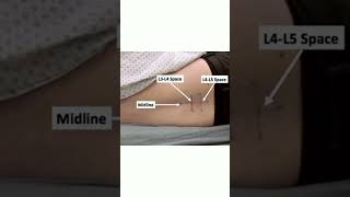 Procedure for lumbar puncture kattrucate lumbarpuncture spinalfluid spinaltap spinalneedle [upl. by Loresz71]