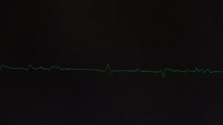 EMG Fibrillations and Fasciculations [upl. by Holland]