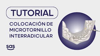 Vídeo de colocación de microtornillo interradicular [upl. by Metsky109]