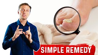 Use Epsom Salt For Toenail Fungus  Treatment For Toenail Fungus – DrBerg [upl. by Croner]