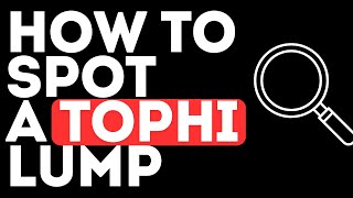 How to Spot a Tophi Lump in Your Body  Gouty Tophi  Gout  Self Examination [upl. by Rayham702]