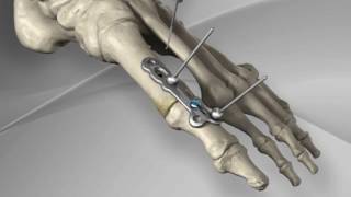 First Metatarsophalangeal Joint Fusion with Arthrex® MTP Fusion Plate [upl. by Langille]