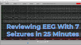 EEG with 7 seizures in 25 minutes [upl. by Dun]