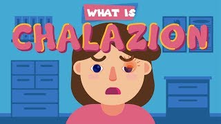 What is Chalazion Final Version [upl. by Arliene165]