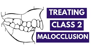 Management of Class 2 Malocclusion Orthodontics [upl. by Juditha]