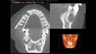 AOT Adenomatoid Odontogenic Tumor confirmed [upl. by Seidel984]