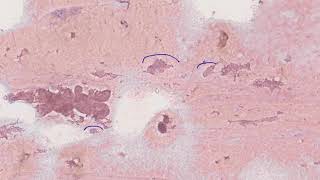 Thyroid cytology Colloid nodule [upl. by Tades295]