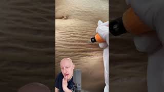 Plasma Pen As A Cure For Stretchmarks  Doctor Reacts [upl. by Analos804]