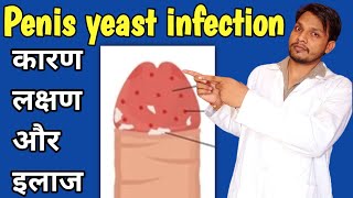 penis yeast infection cause symptoms treatment  Balanitis  ling me infection hone ke karan [upl. by Andromede807]