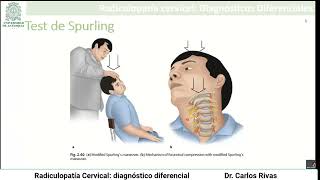 Radiculopatía cervical diagnóstico diferencial [upl. by Simmonds]