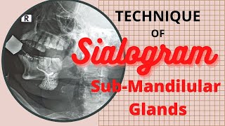 Sialogram of Sub mandibular gland Ep52  Technique of Submandibular gland  procedure Sialography [upl. by Piselli848]