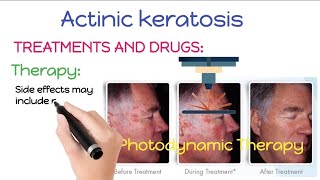 How To Treat and Remove Actinic Keratosis  Actinic Keratosis Treatment And Removal Procedures [upl. by Thoer]