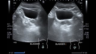 ECOGRAFÍA DE VEJIGA URINARIA VALORACIÓN ECOGRÁFICA DE VEJIGA PARED DIÁMETROS Y MEDIDAS [upl. by Darton400]