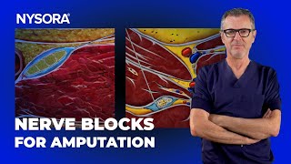 Sciatic  Femoral Nerve Blocks for AKA Amputation [upl. by Grissom]