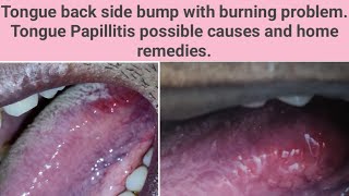 Tongue back side bump with burning problemTongue Papillitis possible causes Diagnosisamphome remedies [upl. by Yenoh843]