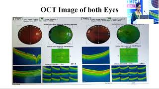 AIOCMTC2 2023 APOS Retina PPS FP673 Dr SIRIPURAPU CASE OF FOVEAL HYPOPLASIA WITH NYSTAGMUS [upl. by Capp]