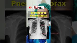 Spontaneous Pneumothorax doctor medical nursing [upl. by Ahsieka896]