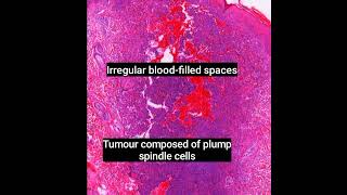 Histopathology of Aneurysmal Dermatofibroma dermpath dermatopathology pathology shorts [upl. by Aneehsar]