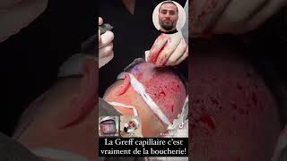 💉🩸Greffe de barbe de ibraTv 😰 [upl. by Stan]