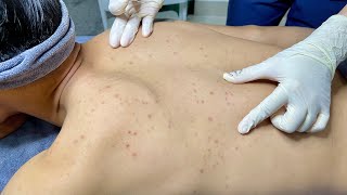 ACNE TREATMENT VU QUYNH MI Acne On Mans Back 2024 [upl. by Lanny493]