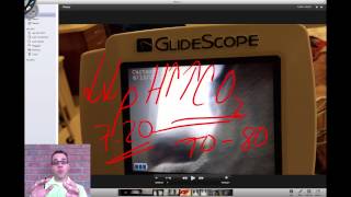 Glidescope intubation and annotation [upl. by Nayb]