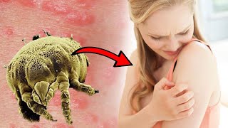 How To Get Rid of Scabies at Home NATURAL HOME REMEDY [upl. by Eelsha]